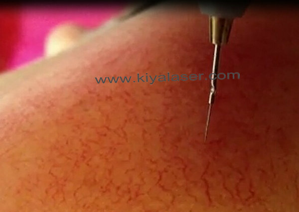 treatment way of vascular.jpg