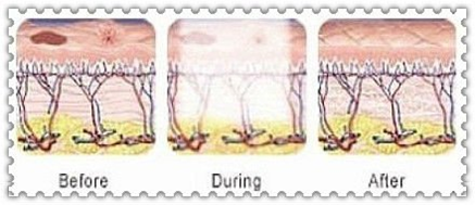 LED Theory treatment process.png